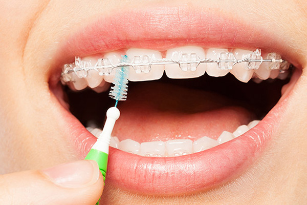 Clear Aligners or Invisible Braces: Everything You Need to Know About Clear  Braces 