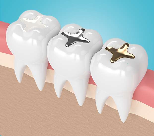 Ashburn Composite Fillings