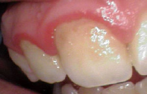 Periodontal Disease