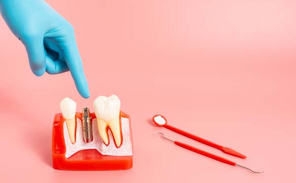 Signs You May Need Dental Implants