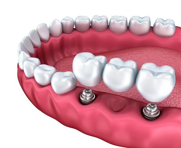 Everything You Should Know About Dental X Rays