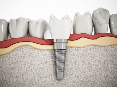 Are You Looking For Mini Dental Implants Near McLean?