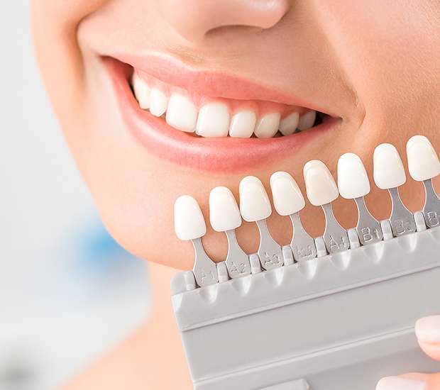 Ashburn Dental Veneers and Dental Laminates