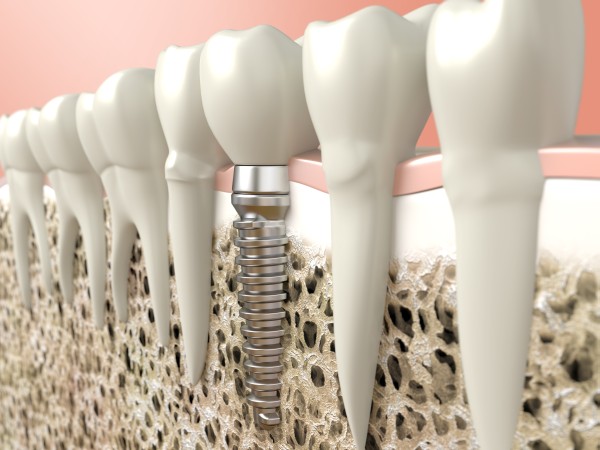Dentures And Implants: Which Is Better?