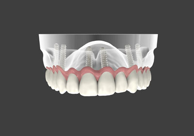Reasons To Choose Implant Supported Dentures