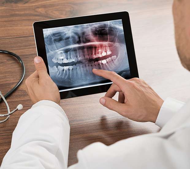 Ashburn Types of Dental Root Fractures